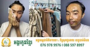 គួរប្រុងប្រយ័ត្ន! បុរសវ័យក្មេងម្នាក់ឆ្លងជំងឺសើស្បែក គួរឱ្យខ្លាចជាងអុតស្វាយក្រោយចូលចិត្តពាក់ខោអាវជជុះ មិនបានបោកទឹក
