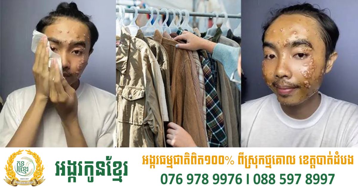 គួរប្រុងប្រយ័ត្ន! បុរសវ័យក្មេងម្នាក់ឆ្លងជំងឺសើស្បែក គួរឱ្យខ្លាចជាងអុតស្វាយក្រោយចូលចិត្តពាក់ខោអាវជជុះ មិនបានបោកទឹក